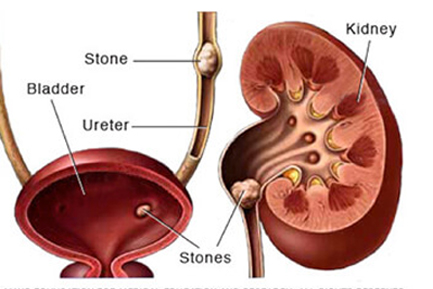 Kidney Stone Treatment in Pun
