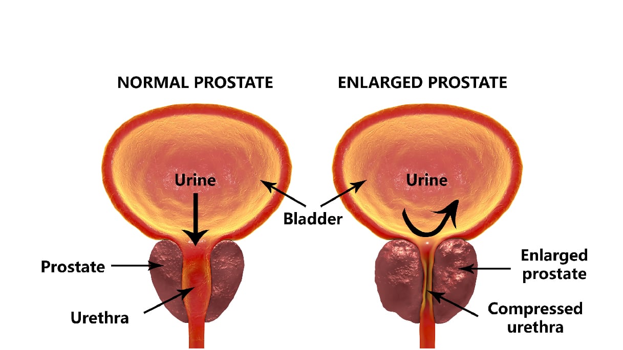 Prostrate cancer doctor in pune,Prostrate cancer treatment in pune