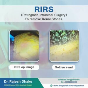 RIRS (Retrograde Intrarenal Surgery)
