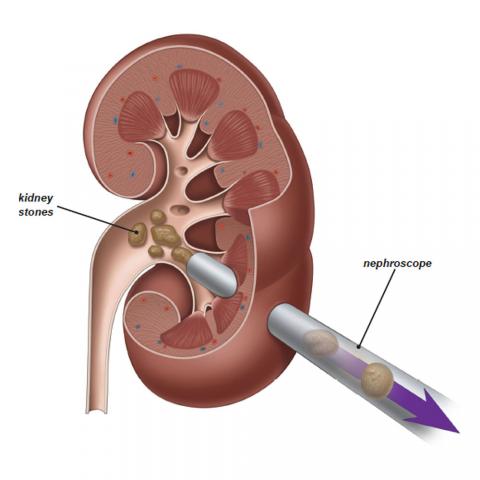 Dr. Rajesh Dhake, Urologist in Pune, Kidney Stone Specialist in Pune , Urologist in Dange Chowk , Kalewadi, Pimpri, Pune, PCMC.