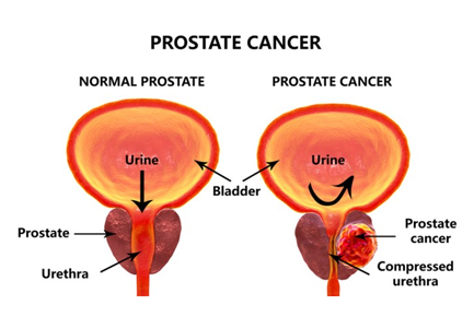 Prostate-Cancer-Doctors-in-Pimpri-Chinchwad-Pune-3