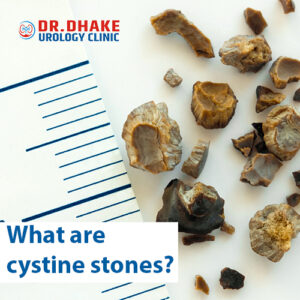 Cystine Stones  Causes, And Treatment Options