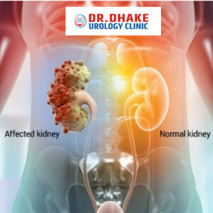 Guidelines for the management of Kidney Cysts