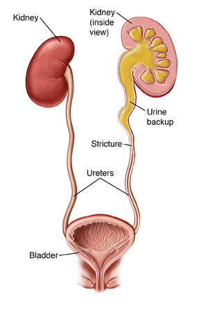 Anterior view of urinary system, left side and bladder in coronal section showing ureteral stricture at left ureteropelvic junction and dilated kidney with urine reflux. SOURCE: pickup from 60533

60532A Also in 40091_3, originally based on 5A11872  MOD: Added stricture and dilated kidney with urine reflux, from 40099_1