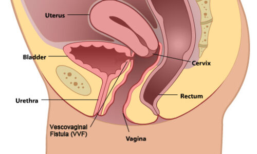 Vescivaginal-Fistula