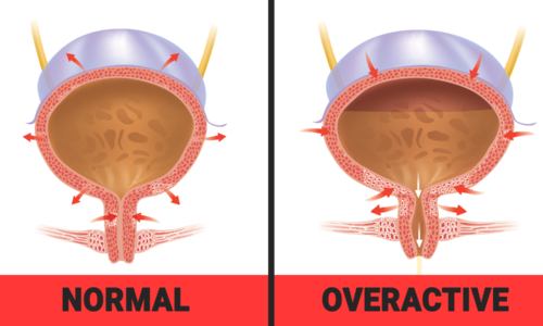 overactive-bladder