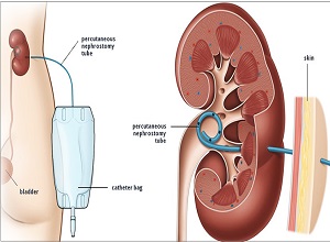 Dr. Rajesh Dhake, Urologist in Pune, Kidney Stone Specialist in Pune , Urologist in Dange Chowk , Kalewadi, Pimpri, Pune, PCMC.