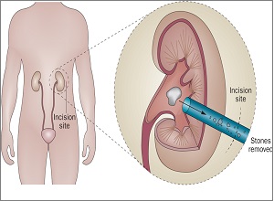 Dr. Rajesh Dhake, Urologist in Pune, Kidney Stone Specialist in Pune , Urologist in Dange Chowk , Kalewadi, Pimpri, Pune, PCMC.