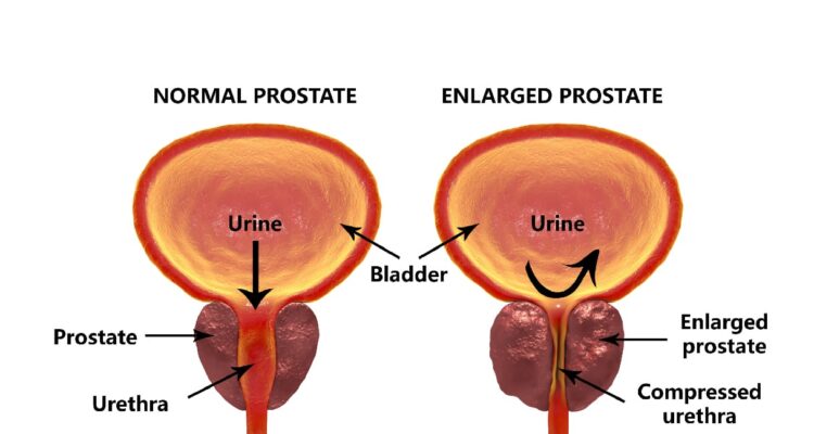 prostate-surgery