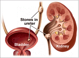 Dr. Rajesh Dhake, Urologist in Pune, Kidney Stone Specialist in Pune , Urologist in Dange Chowk , Kalewadi, Pimpri, Pune, PCMC.