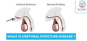 What is Urethral Stricture Disease?