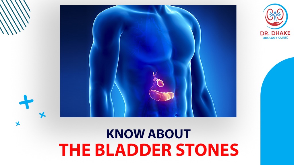 What Everyone Should Know About The Bladder Stones
