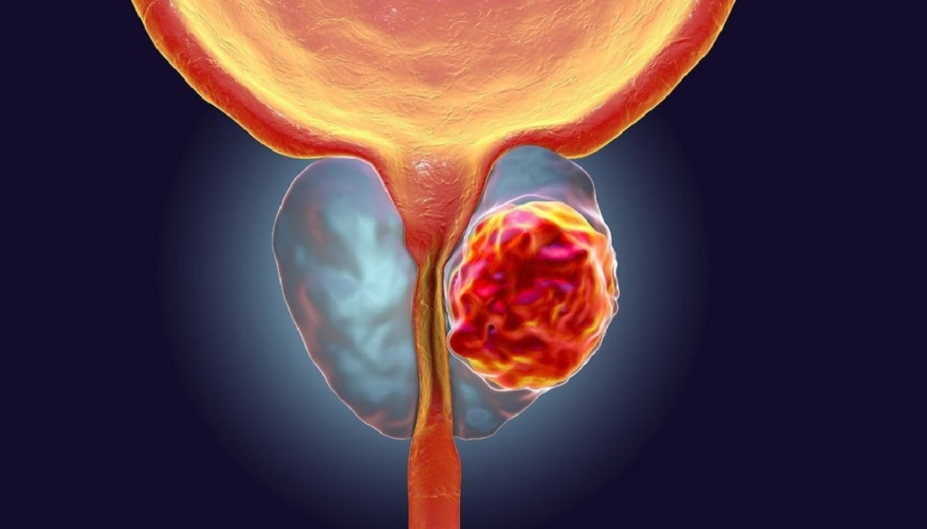 Understanding Prostate Cancer Stages and Grading: A Guide to Informed Treatment