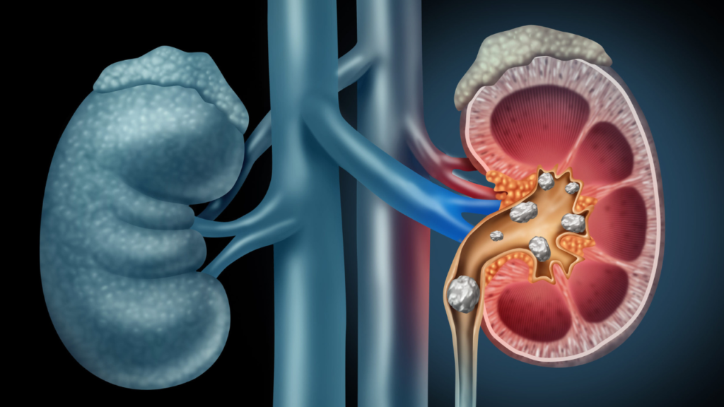 Understanding Laser Treatment for Kidney Stones: A Comprehensive Guide