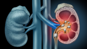 Understanding Laser Treatment for Kidney Stones: A Comprehensive Guide