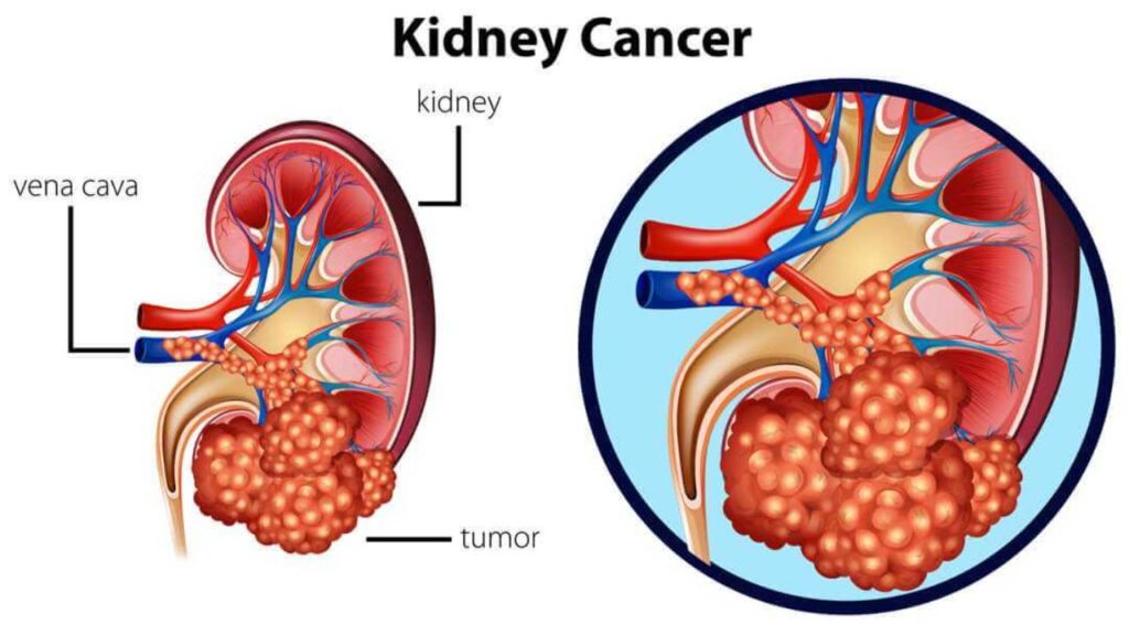 Lifestyle Changes to Lower Risk of Kidney Cancer