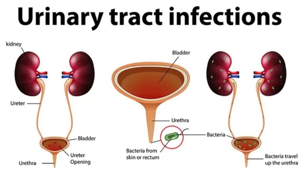 Understanding Urinary Tract Infections: Types, causes, symptoms, and treatment options.
