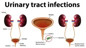 Understanding Urinary Tract Infections: Types, causes, symptoms, and treatment options.