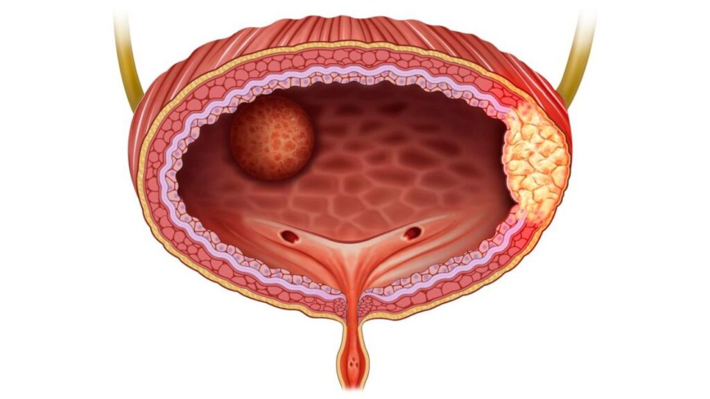 Bladder Cancer: Causes, Symptoms, and Treatment