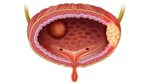 Bladder Cancer: Causes, Symptoms, and Treatment