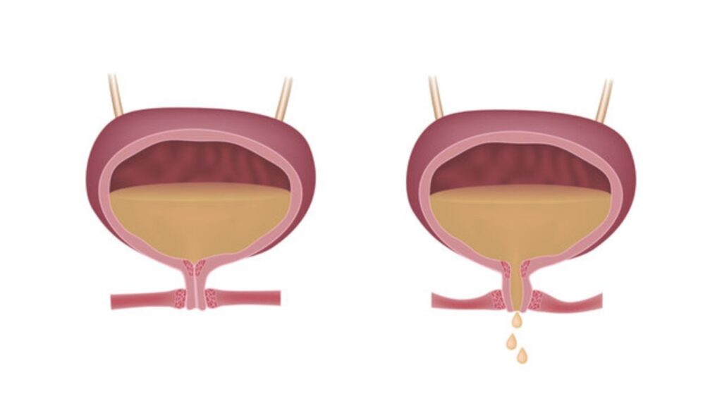 Female Urinary Incontinence: Causes, Treatments, and Lifestyle Adjustments