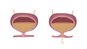 Female Urinary Incontinence: Causes, Treatments, and Lifestyle Adjustments