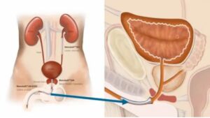 Recognizing and Treating Urethral Stricture: Symptoms and Surgical Solutions