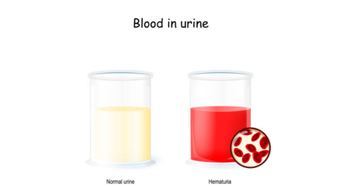 Blood in Urine (Hematuria): What It Means and When to Worry