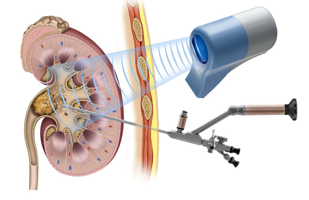 Laser vs Conventional Surgery for Kidney Stones: What You Need to Know