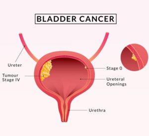Bladder Cancer Awareness: Early Detection Can Save Lives