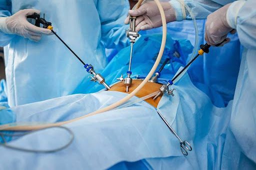 Laparoscopic Urology Surgery: A Modern, Painless Approach to Urological Care