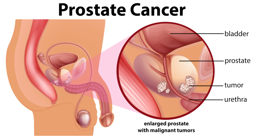 Prostate treatment by urology surgeon in Pune
